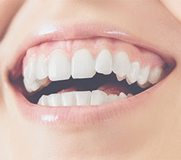 Sport : comment protéger vos dents ? - Cabinet dentaire Dent Doche