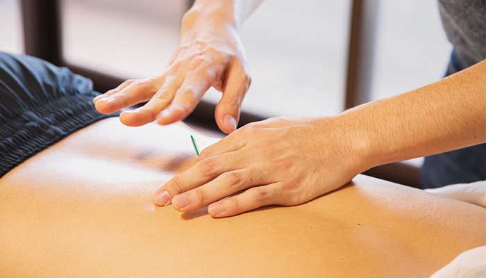 Qu'est-ce que l'acupuncture?