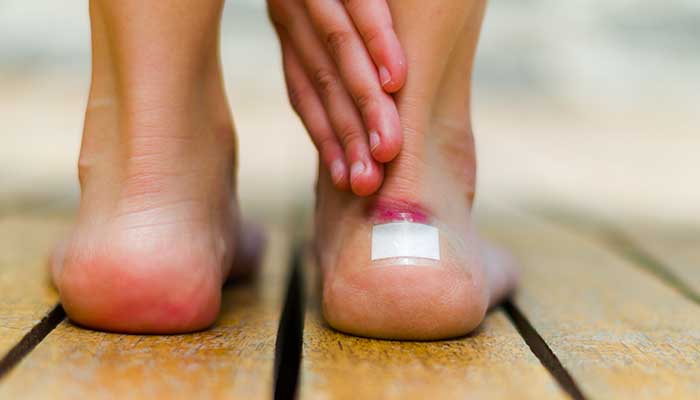 Ampoules, comment prendre soin de ses pieds ?