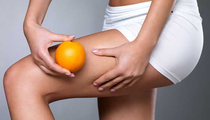 Tout savoir sur la cellulite