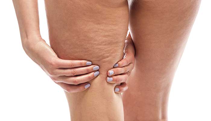 Les solutions naturelles anti-cellulite 