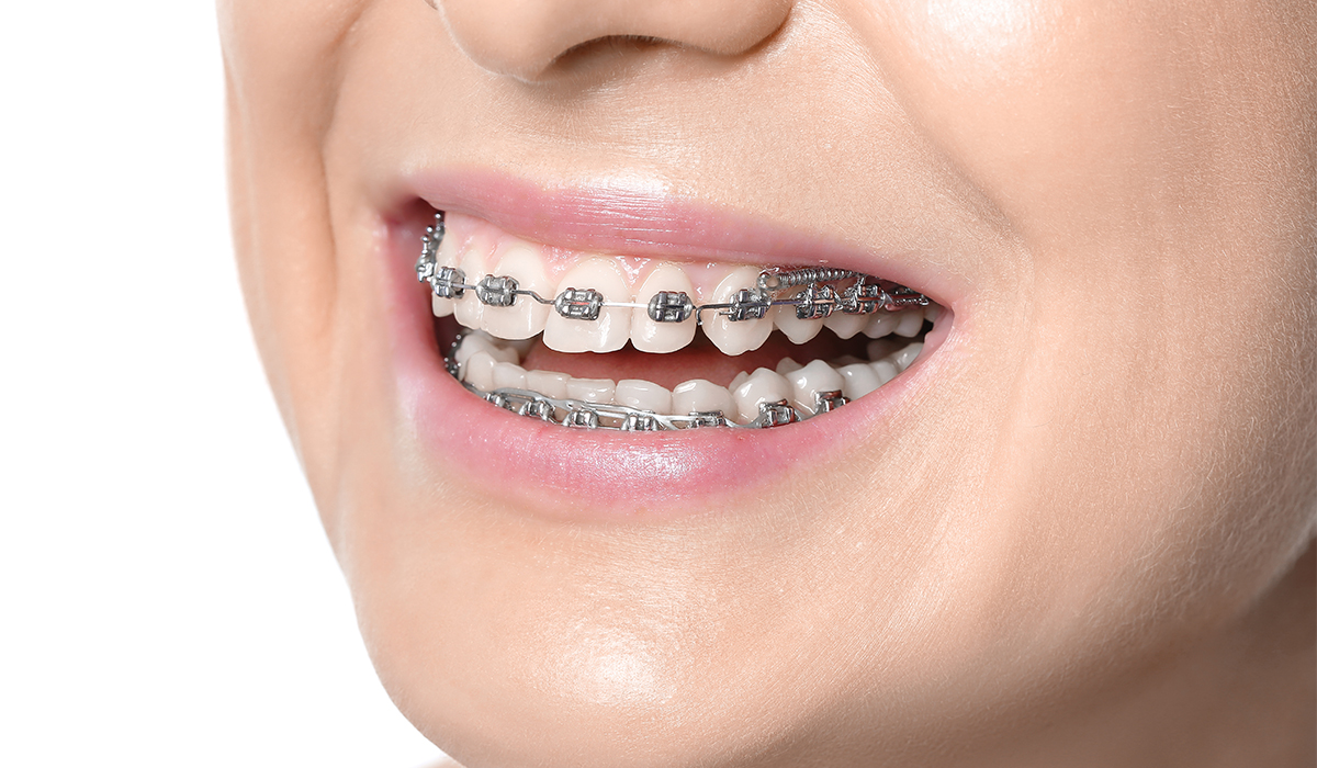 Aligner ses dents : les alternatives aux appareils dentaires