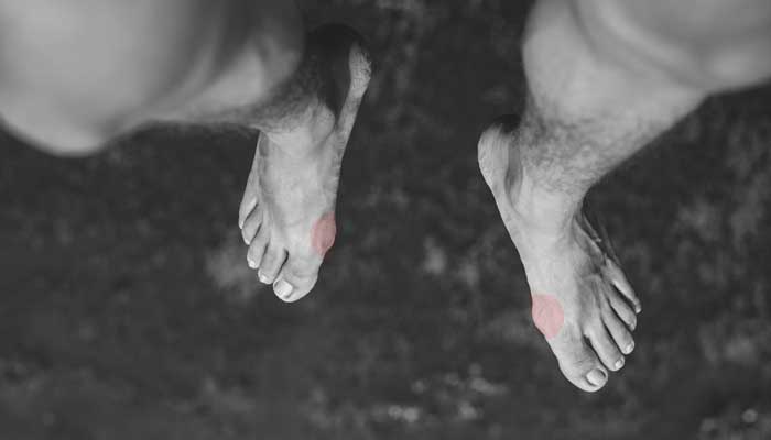 Hallux Valgus, tout savoir sur l’oignon au pied