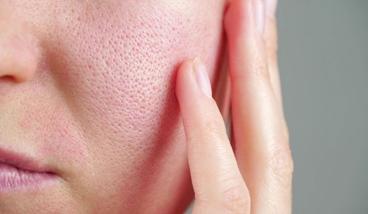 Pores dilatés ? Découvrez comment les resserrer naturellement