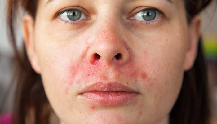 Psoriasis sur le visage : comment agir ? | La Vie Naturelle